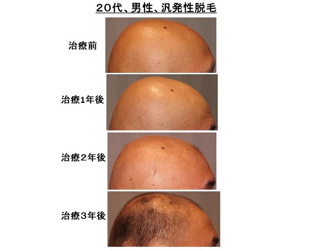 円形脱毛症　病院""